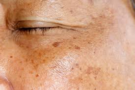 Common types of hyperpigmentation