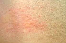 Skin inflammation